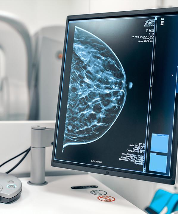 radiographie mammogramme